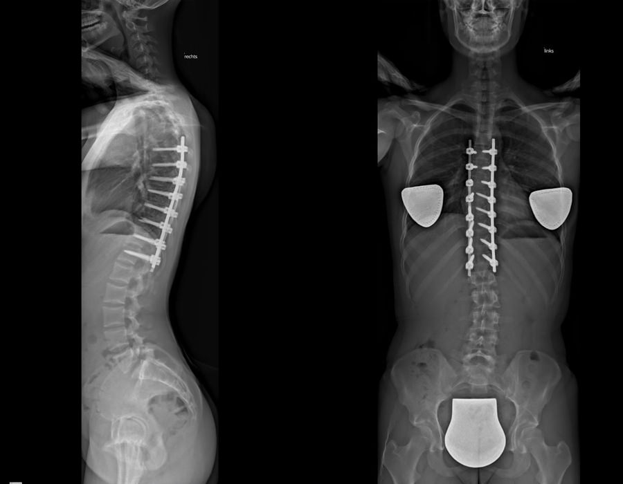 Behandlung von Skoliose nach der OP durch Prof. Dr. Halm