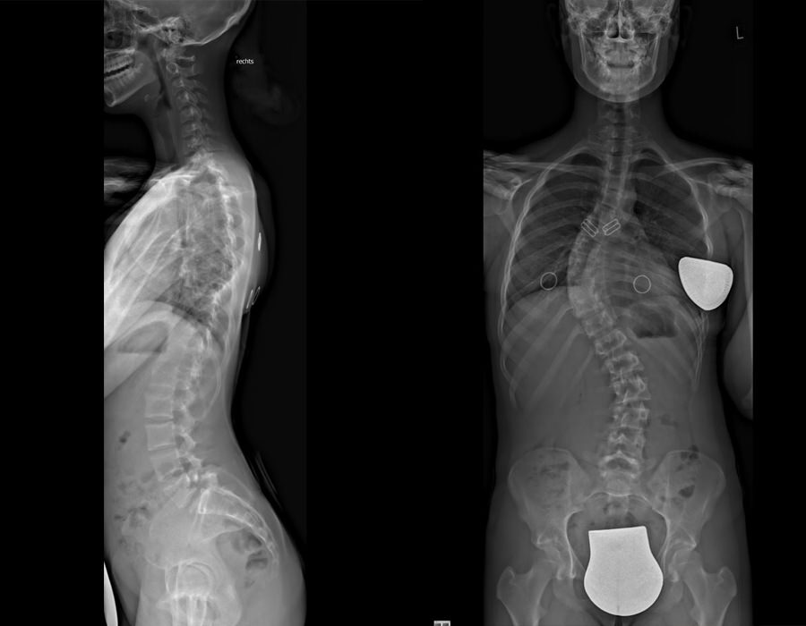 Behandlung von Skoliose vor der OP durch Prof. Dr. Halm