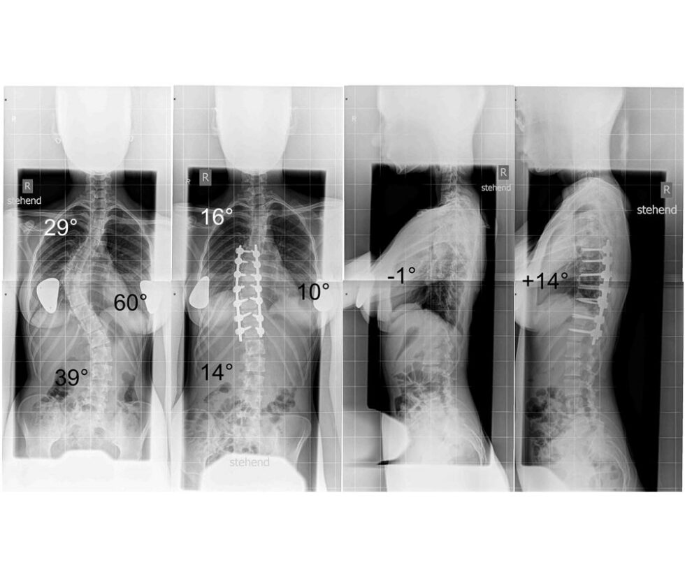 Skoliosebehandlung bei Prof. Dr. Halm | HALM SPINE