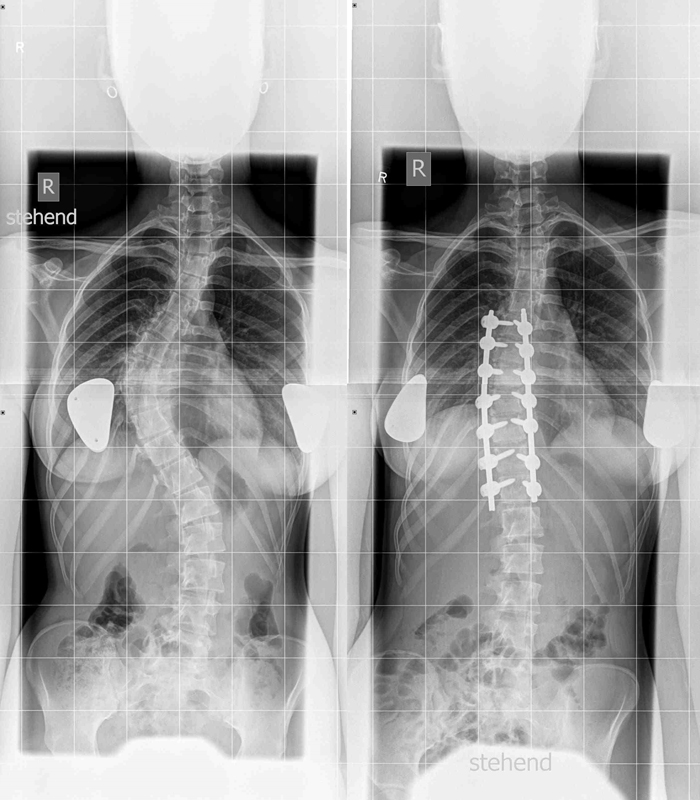 Krankheitsbild Skoliose - Behandlung durch Prof. Dr. Halm